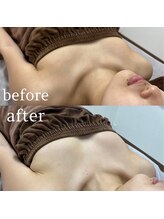 エレノア 錦糸町(ELEANOR)/BBLバストアップ 光豊胸エステ