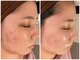 エス(S)の写真/【肌変化を実感！同世代の中でも一際輝く素肌美人へ】芸能人御用達で人気のハーブピーリングで肌悩み改善◎