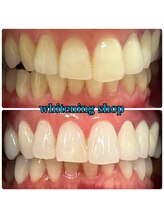 ホワイトニングショップ 八重瀬店/【ビフォーアフター】美白