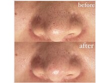 アンヴィウラ/毛穴の悩みを解決！