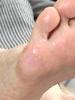 001 新横浜/タコやウオノメは一回で施術終了