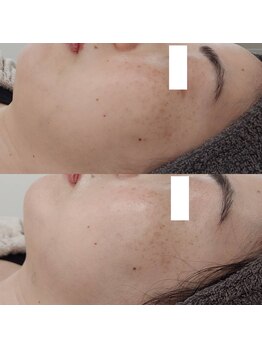 ヴェルシック(Belchic)/首もプラスで施術が可能