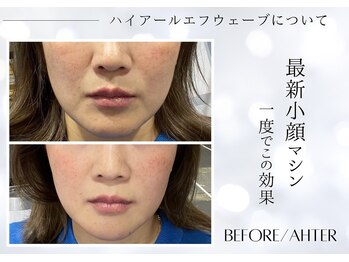 ユアーズ ビューティー(YOURS beauty)/1回で驚きの小顔へ☆