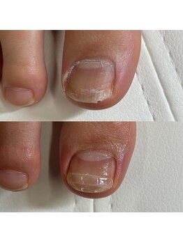 リリ(lili)/巻き爪矯正/3回目