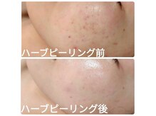 ラ リノ 星ヶ丘(La Lino)の雰囲気（乾燥するこの季節に増えるニキビ！保湿と毛穴ケアで艶肌に♪）