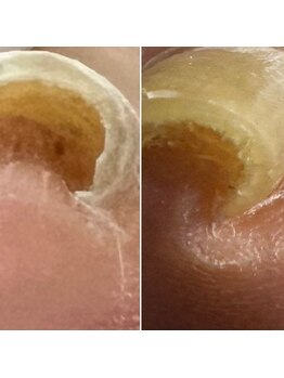 ルーチェ バイ フェリシア(LUCE by Felicia)/【巻き爪ケア】アクリル使用☆