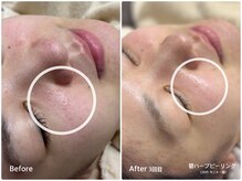 ラウレア(LAULEA)/ハーブピーリングBefore/after