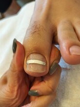 エピス(Epice)/巻爪矯正