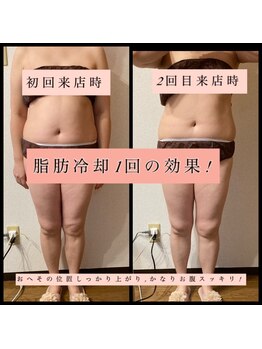 ティアメディカル(Tia Medical)/【脂肪冷却お腹1回の効果】