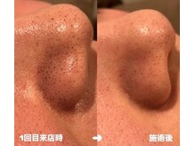 モアトゥインクル 山口店(MORE twinkle)/★症例写真★【30代】