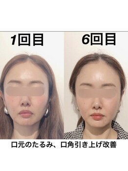 経堂鍼灸整体院/口角上げフェイスラインすっきり