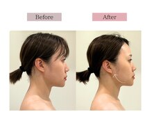 フロリール アザブジュウバン(FlorirAzabujuban)/小顔フェイシャル/リフト