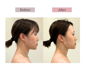 フロリール アザブジュウバン(FlorirAzabujuban)/小顔フェイシャル/リフト