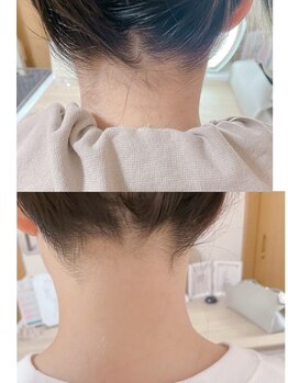 ニコリ(Nicori)/痛みの少ない脱毛