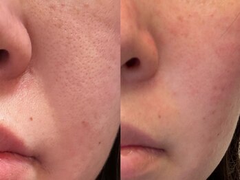 ゼニス 池袋本店(ZENITH)/たるみ毛穴撃退◎