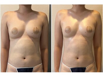 モア(moa)/まんまるバスト