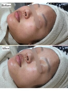 ソワナ(soina)/【神楽坂駅/フェイシャル/毛穴】