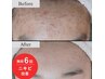 結果重視の最新美容液＆機器で毛穴・ニキビ改善フェイシャル60分