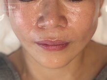 キュレイテッドスキン(CURATED SKIN)/ピーリング/毛穴ケア/肌質改善