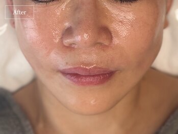 キュレイテッドスキン(CURATED SKIN)/ピーリング/毛穴ケア/肌質改善