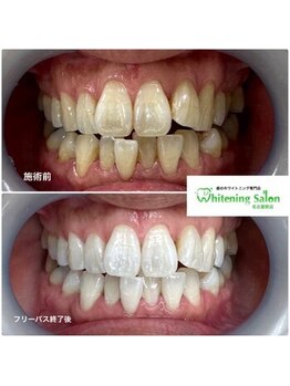 ホワイトニングサロン 名古屋駅店/【ホワイトニング施術例】