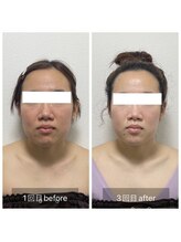 メロウゴールド(Mellow Gold)/WINBACK×ハーブピーリング3回