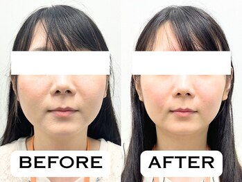 ビハリスト 恵比寿/スッキリ小顔に!