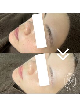 ハルミ 美容整体 新宿店(Harumi)の写真/新宿★キメの整った美肌へ導くハーブピーリング¥5500!古い角質を除去し“むき卵”のようなツヤ美肌へ♪