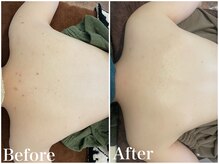 サロンドフェイス(Salon de Faith)/背中ハーブ