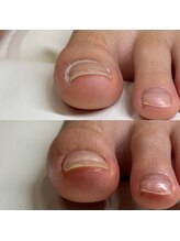 リリ(lili)/巻き爪矯正/3回目