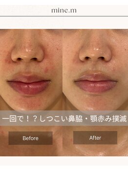 マインエム(mine.m)/刺さないリジュランアンプル