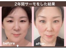 サロン リボン(salon Ribon)の雰囲気（小顔マシンの王様！で、ハリを出しながら小顔に整えます）