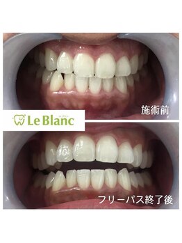 ルブラン 奈良店(Le Blanc)/口元の準備できてますか？