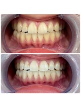 エクシアホワイトニング 日本橋店/茅場町ホワイトニング