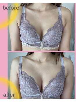 ラジュワード(lajward)の写真/【１度の施術でここまで溢れる】もっちり、本来の位置に♪ワンサイズアップでふわふわバストへ
