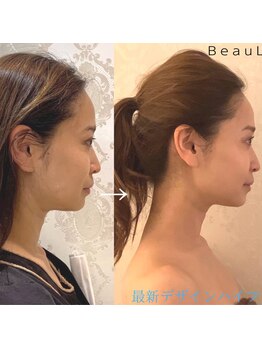 ビュール 銀座(BeauL)/最新デザイン小顔