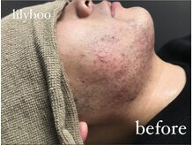 リリーブー 池袋(Lilyboo)/ヒゲ脱毛