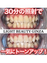 ライトビューティー 銀座店(LightBeauty)/東銀座　ホワイトニング症例写真