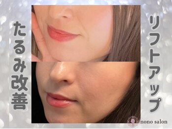 ノノサロン(nono salon)/ほうれい線/たるみケア