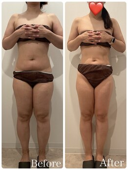 まろん鍼灸接骨院 立川店/痩身エステ（下半身）