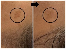 エフェクト 塚口店(effect)/Before After &nbsp;&nbsp;50代/7回目