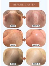 リュミエール デスポワール(Lumiere d'espoir)/毛穴洗浄