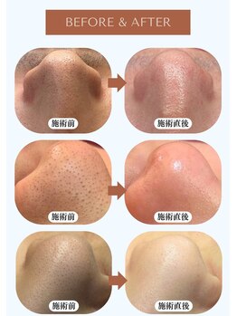 リュミエール デスポワール(Lumiere d'espoir)/毛穴洗浄