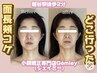 【頬コケ改善に特化！】頬コケでお悩みのお客様はコチラ！(所要時間90分)