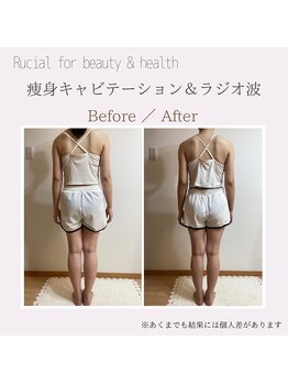 ルシアル(Rucial)/痩身◇ビフォー／アフター