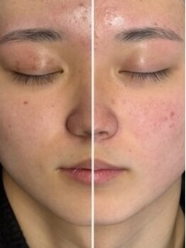 アイズ 福山店(eye's)の写真/【眉毛とSETでフェイシャルWAX脱毛☆】産毛や古い角質をお手入れし、透明感のあるキレイな素肌に♪