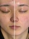 アイズ 福山店(eye's)の写真/【眉毛とSETでフェイシャルWAX脱毛☆】産毛や古い角質をお手入れし、透明感のあるキレイな素肌に♪