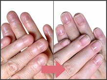 アモ 坂戸(’Amo)/深爪矯正・自爪育成 坂戸/北坂戸