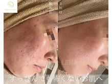 サロン ド レナ(Salon de LENA)/ハーブピーリング サロンドレナ