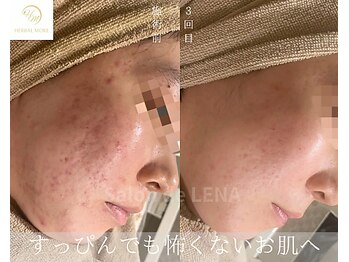 サロン ド レナ(Salon de LENA)/ハーブピーリング サロンドレナ